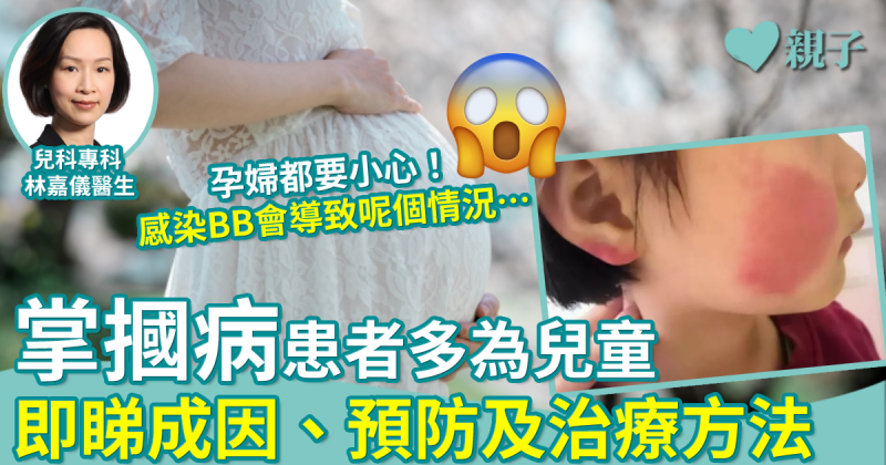 兒童健康｜第五病患者多為兒童　面頰呈紅疹如被掌摑