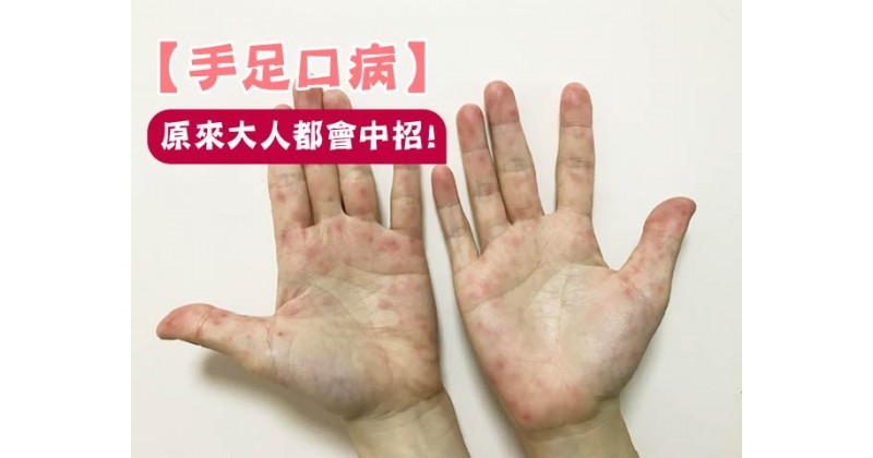 【手足口病】原來大人都會中招﹗