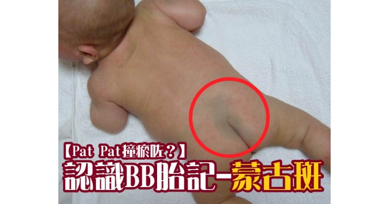 【Pat Pat撞瘀咗？】認識BB胎記-蒙古斑