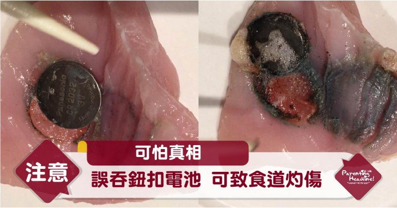 【可怕真相】誤吞鈕扣電池 可致食道灼傷
